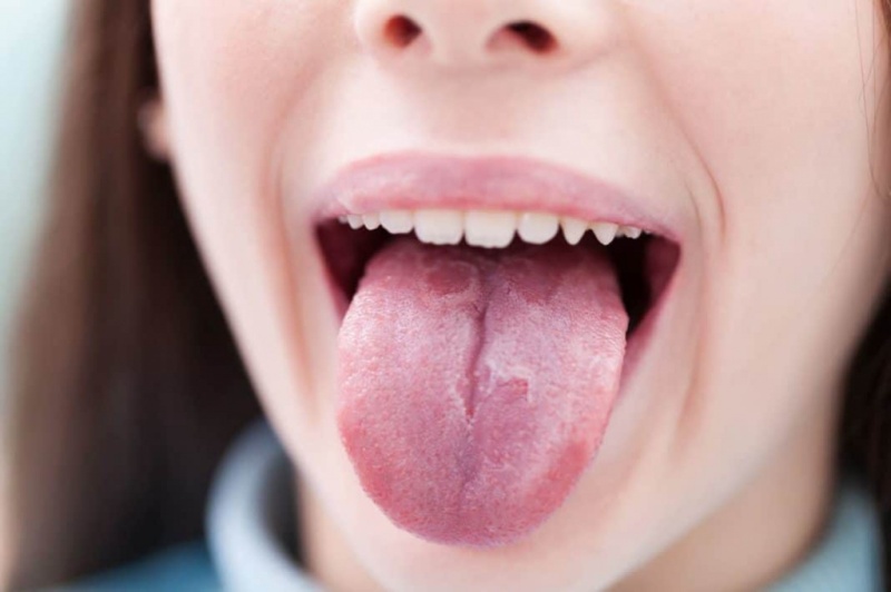 Рак языка: симптомы и современные методы лечения