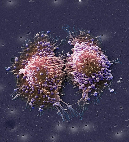 Производные артемизинина инактивируют ассоциированные с раком фибробласты путем подавления передачи сигналов трансформирующего ростового фактора бета при раке молочной железы