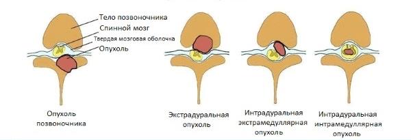 РакПозвоночника6 РакПозвоночника6