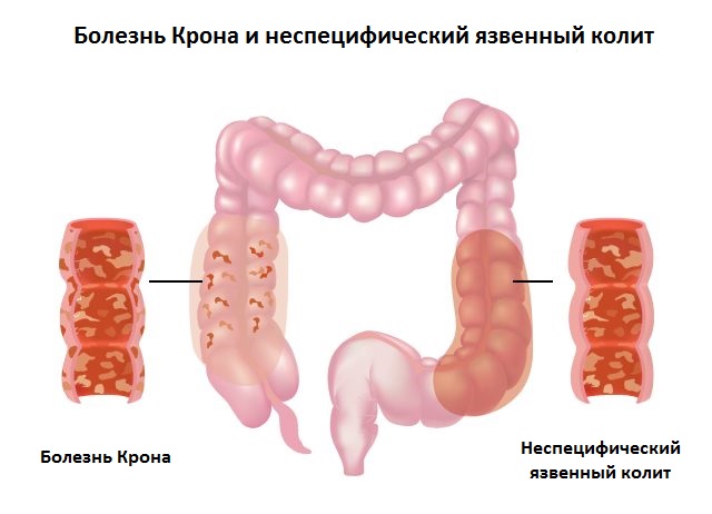 РакТолстойКишки8