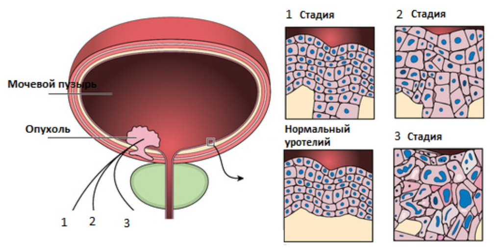 РакМочевогоПузыря