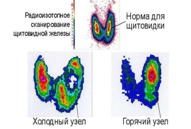 РакЩитовидной9