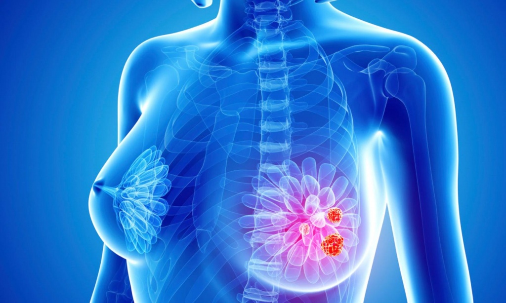 РакМЖелезы РакМЖелезы