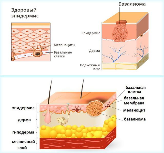Базалиома Базалиома