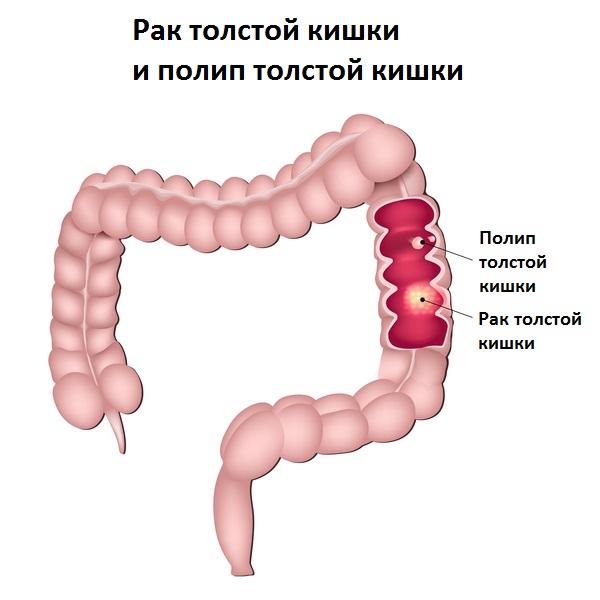 РакТолстойКишки8