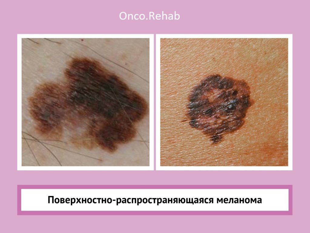 Меланома3 Меланома3