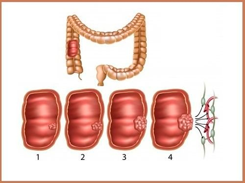 РакСлепойКишки4 РакСлепойКишки4