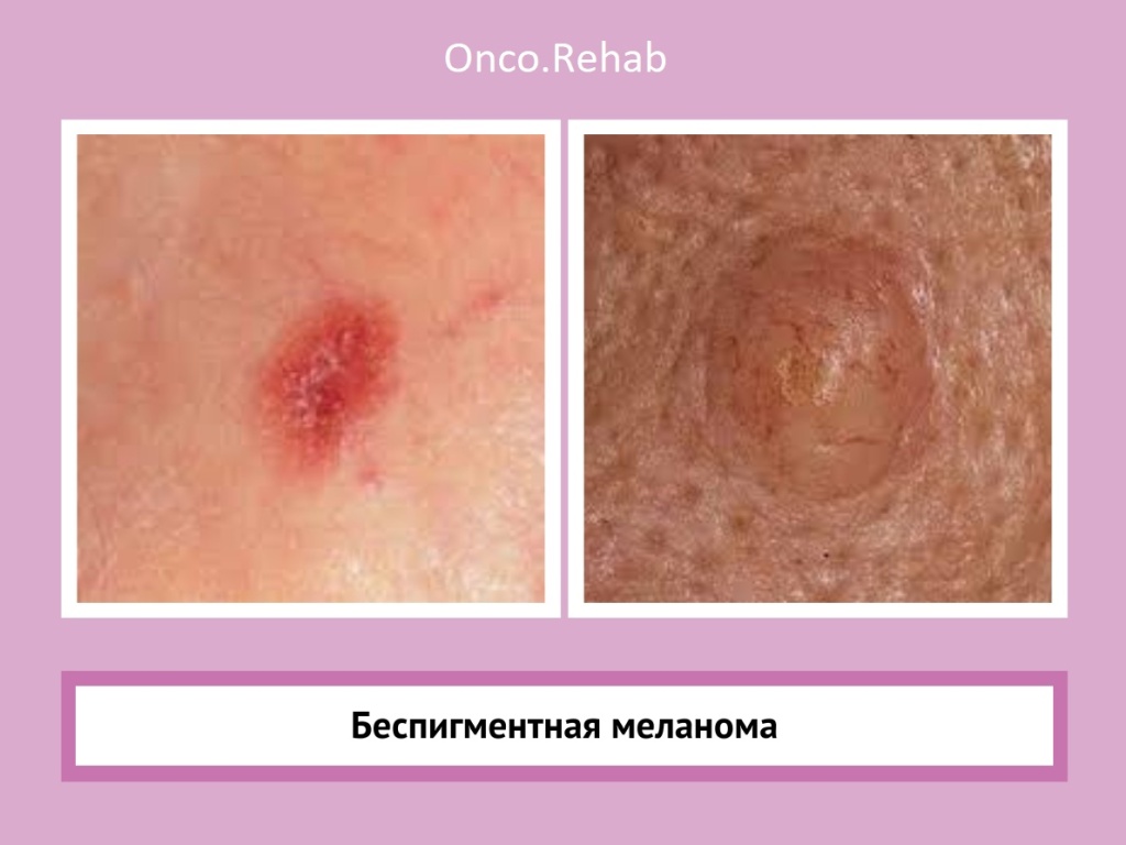 Меланома6 Меланома6