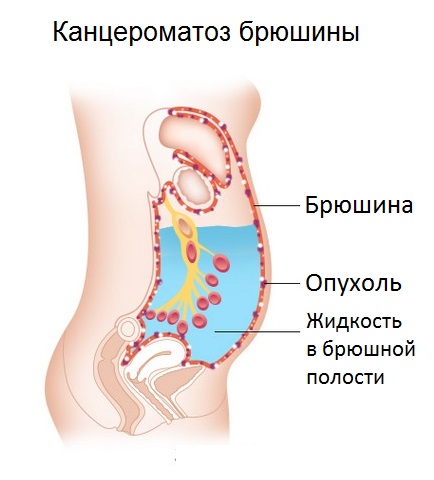 Канцероматоз4 Канцероматоз4