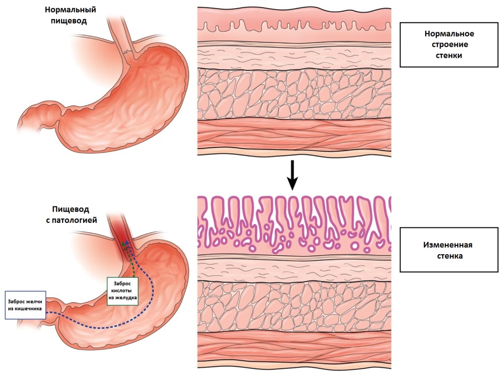 РакПищевода3 РакПищевода3