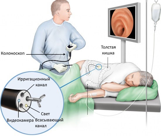 РакОбодочнойКишки5