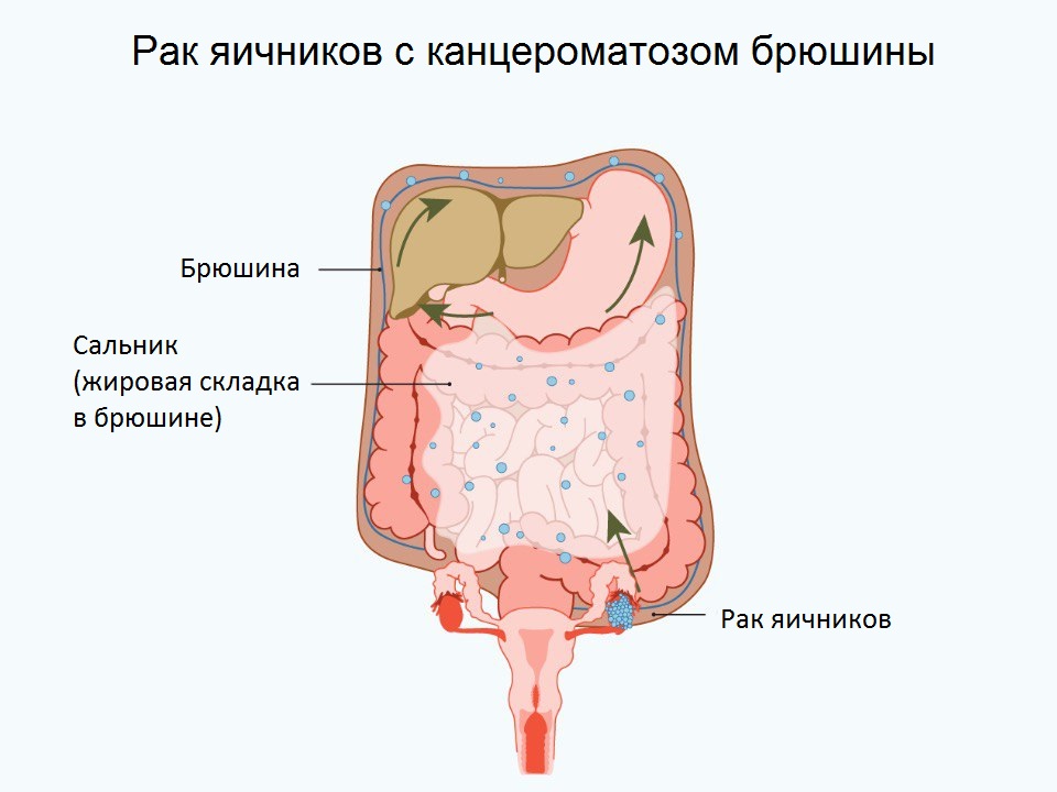 Мр картина канцероматоза