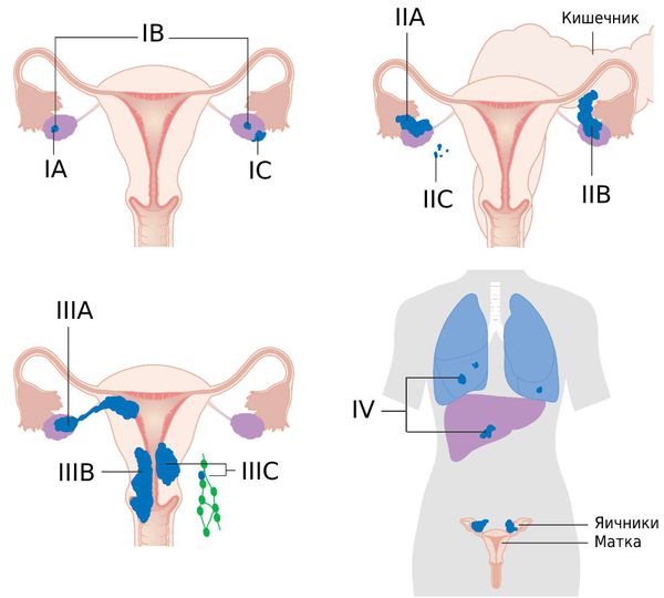 Рак яичников у женщин – симптомы, стадии, диагностика и лечение