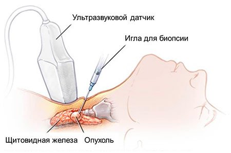 РакЩитовидной10