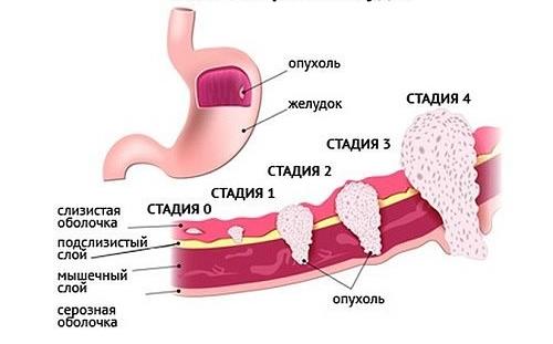 РакЖелудка5