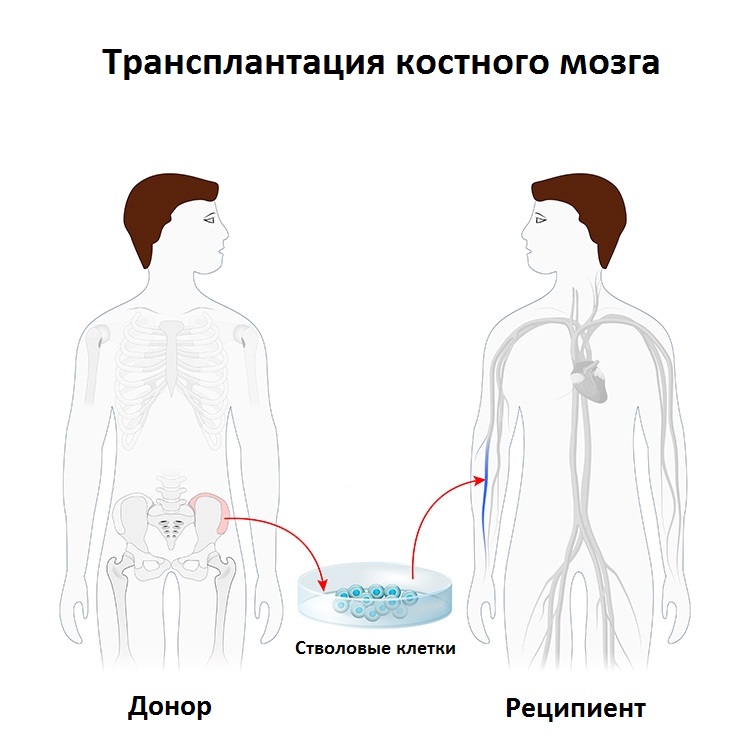 Лейкемия3 Лейкемия3
