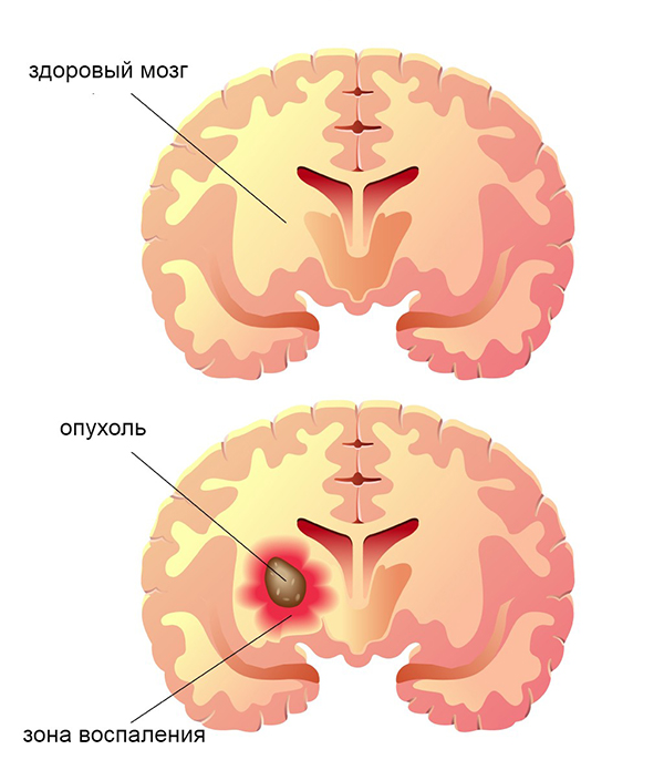 Глиома2 Глиома2