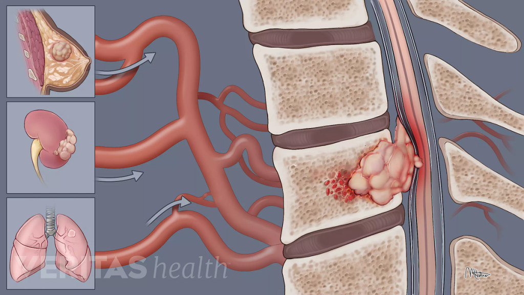 РакПозвоночника5 РакПозвоночника5