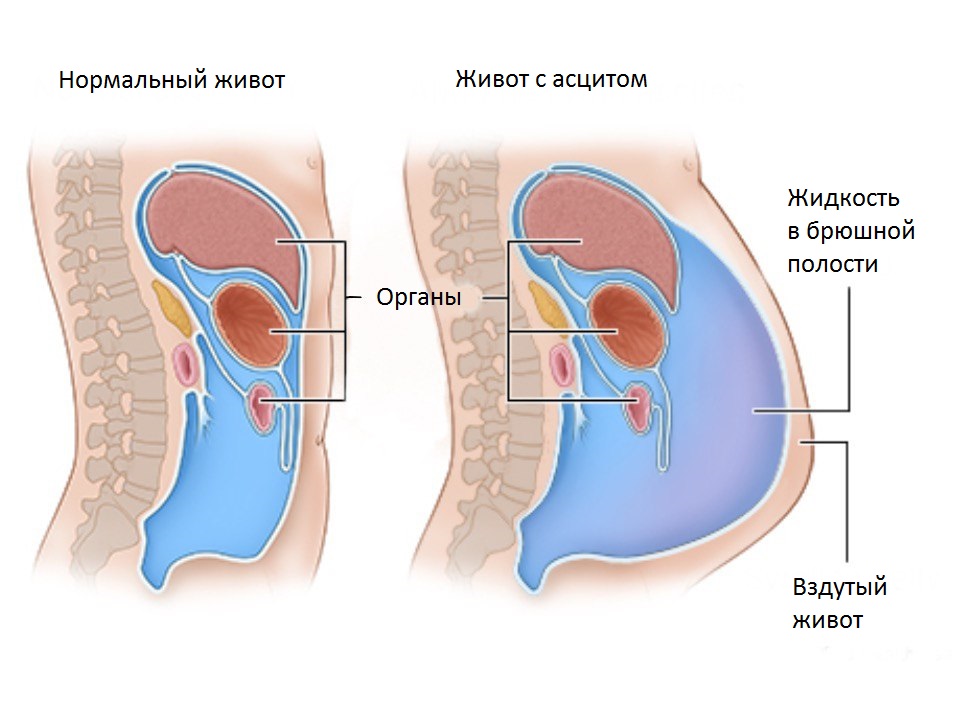Канцероматоз3 Канцероматоз3