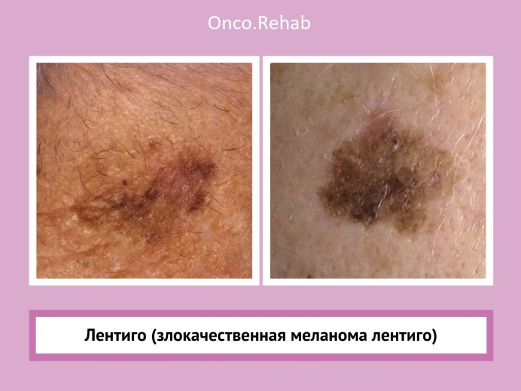 Меланома5 Меланома5