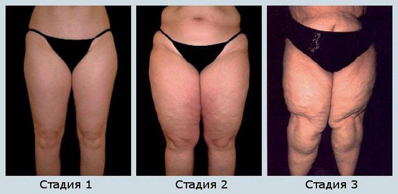 Лимфостаз2 Лимфостаз2