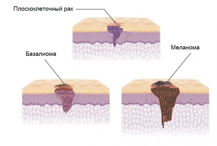 РакКожи6