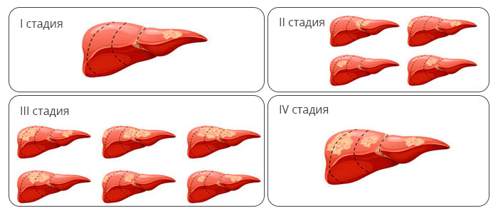 Рак Печени3