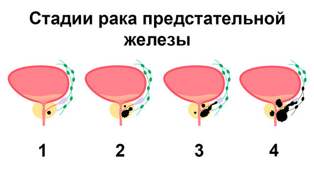 РакПредстательной3 РакПредстательной3