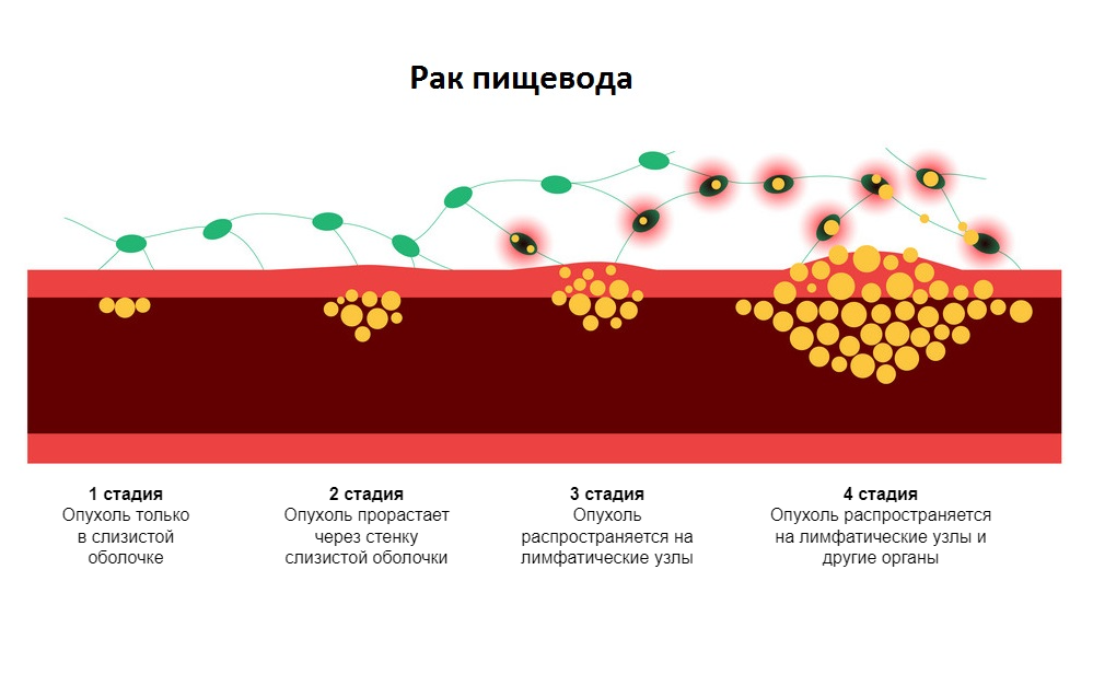 РакПищевода7 РакПищевода7