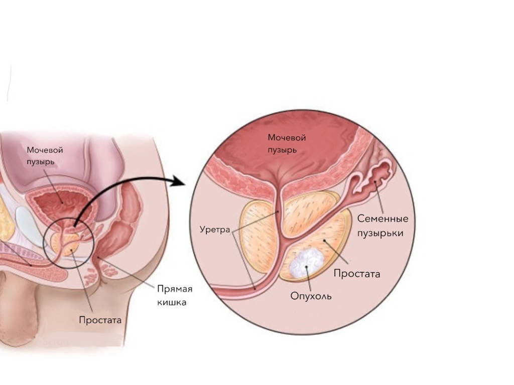 РакПредстательной РакПредстательной