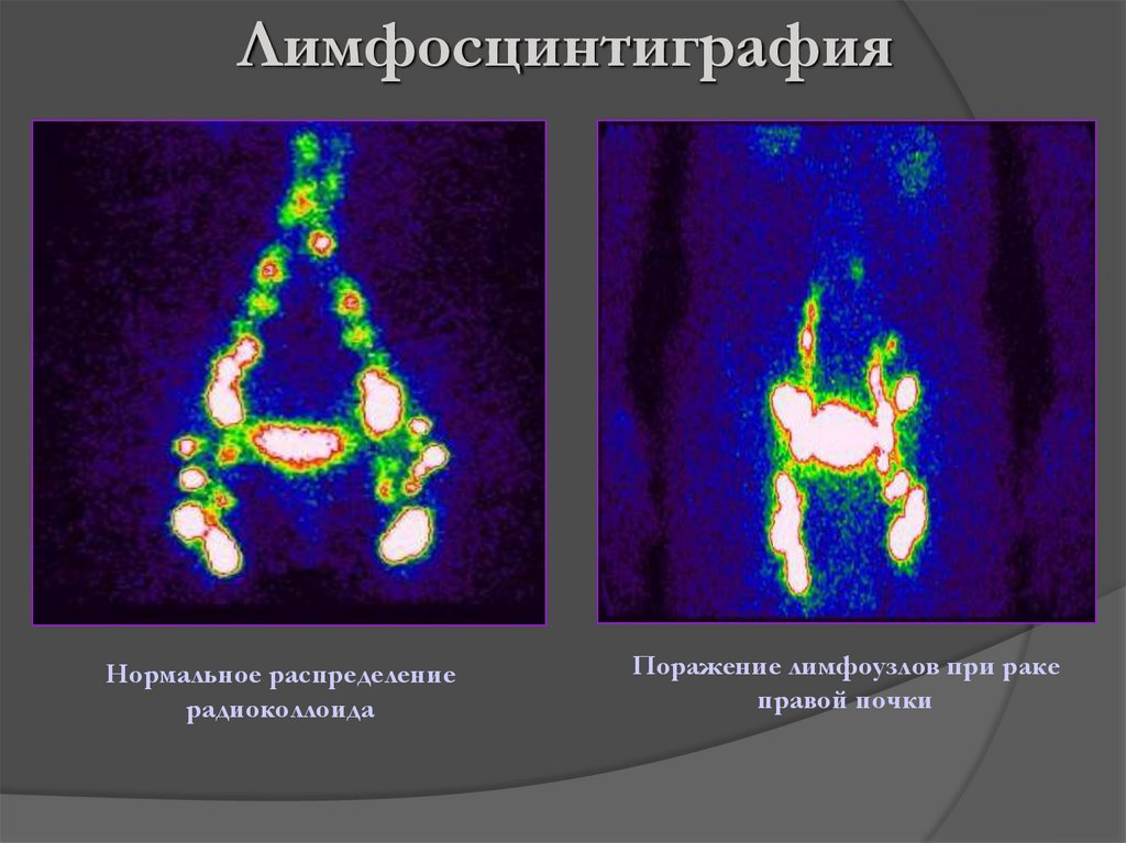 Лимфостаз – что нужно знать о нем при его диагностике и лечении