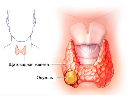 РакЩитовидной5