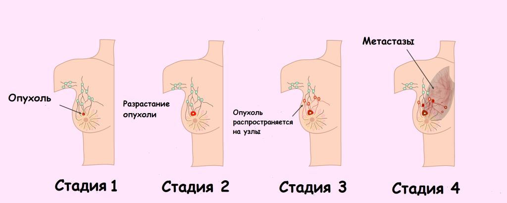 РакМолочнойЖелезы РакМолочнойЖелезы