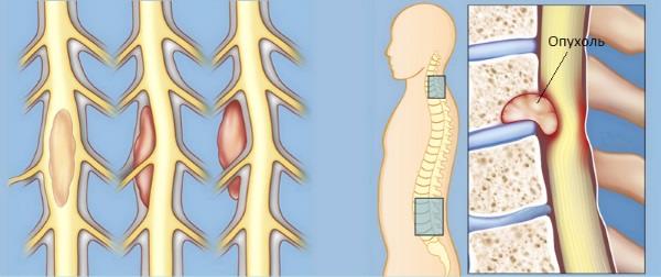 РакПозвоночника2 РакПозвоночника2