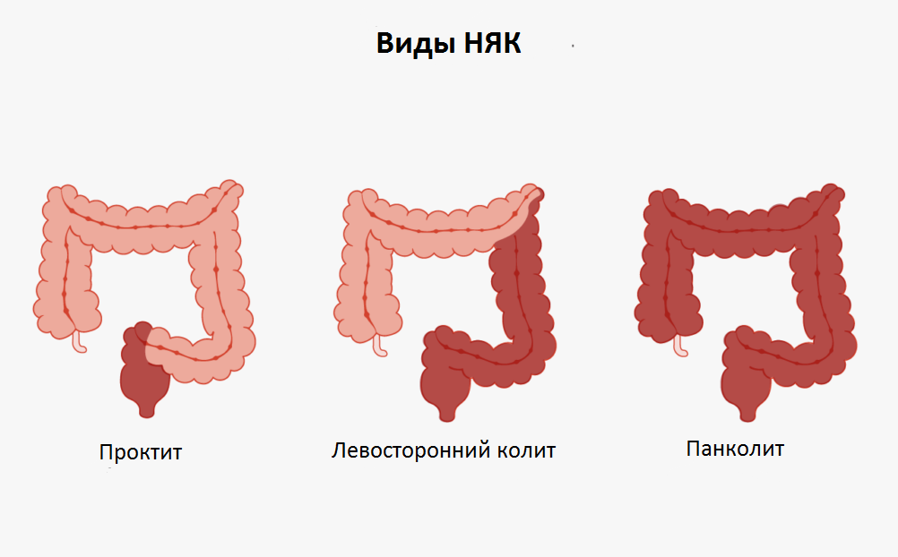 РакТолстойКишки5