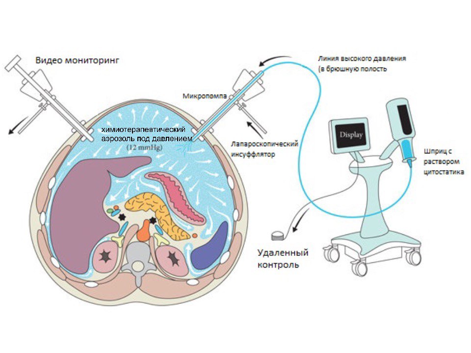 Канцероматоз8 Канцероматоз8
