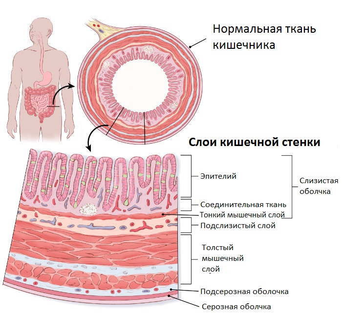 РакТолстойКишки2