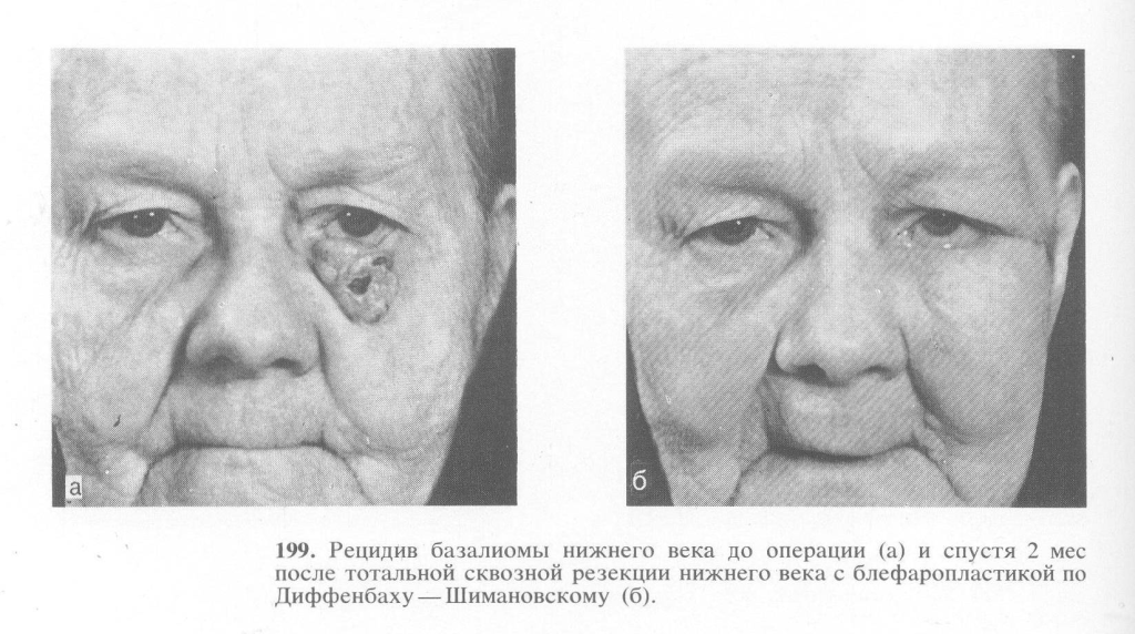 Базалиома3 Базалиома3