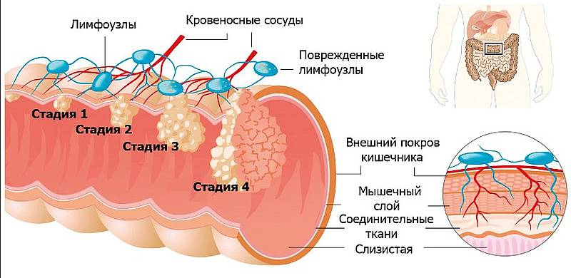 Рак ободочной кишки – почему он возникает и как избавиться от этого онкологического заболевания