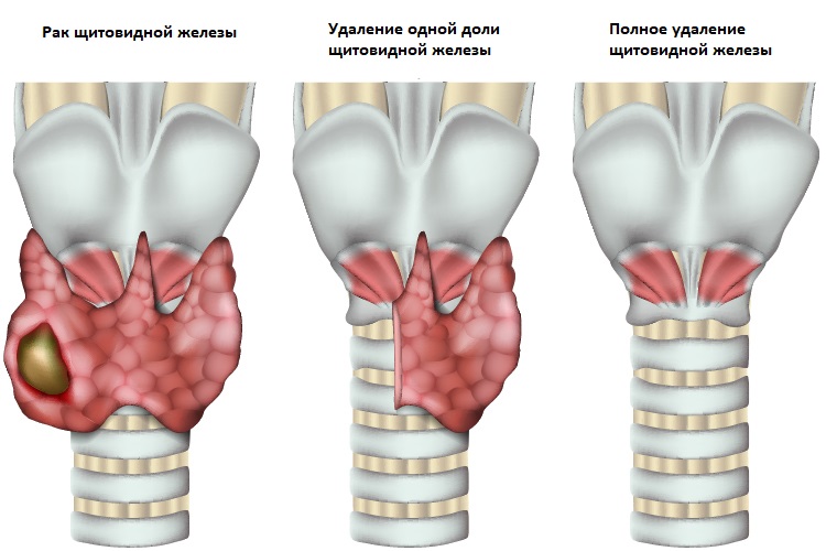РакЩитовидной11
