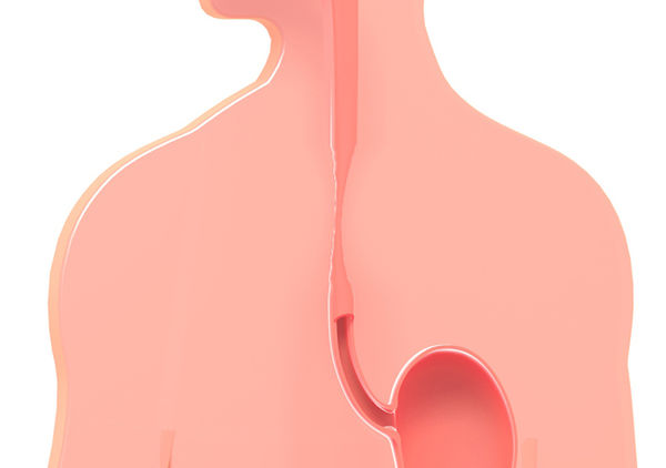 РакПищевода5 РакПищевода5