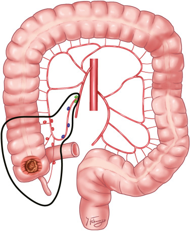РакСлепойКишки3 РакСлепойКишки3
