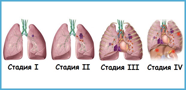 РакЛегких3