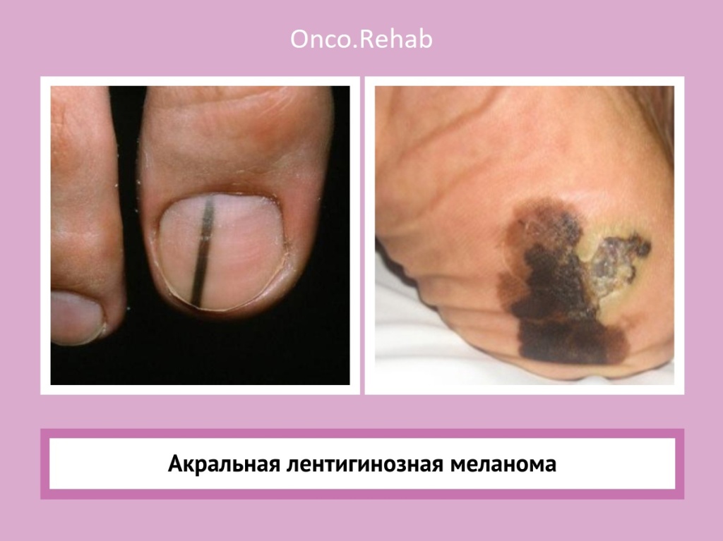 Меланома6 Меланома6
