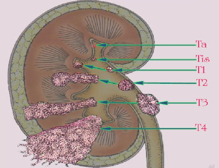 РакМочеточника2 РакМочеточника2