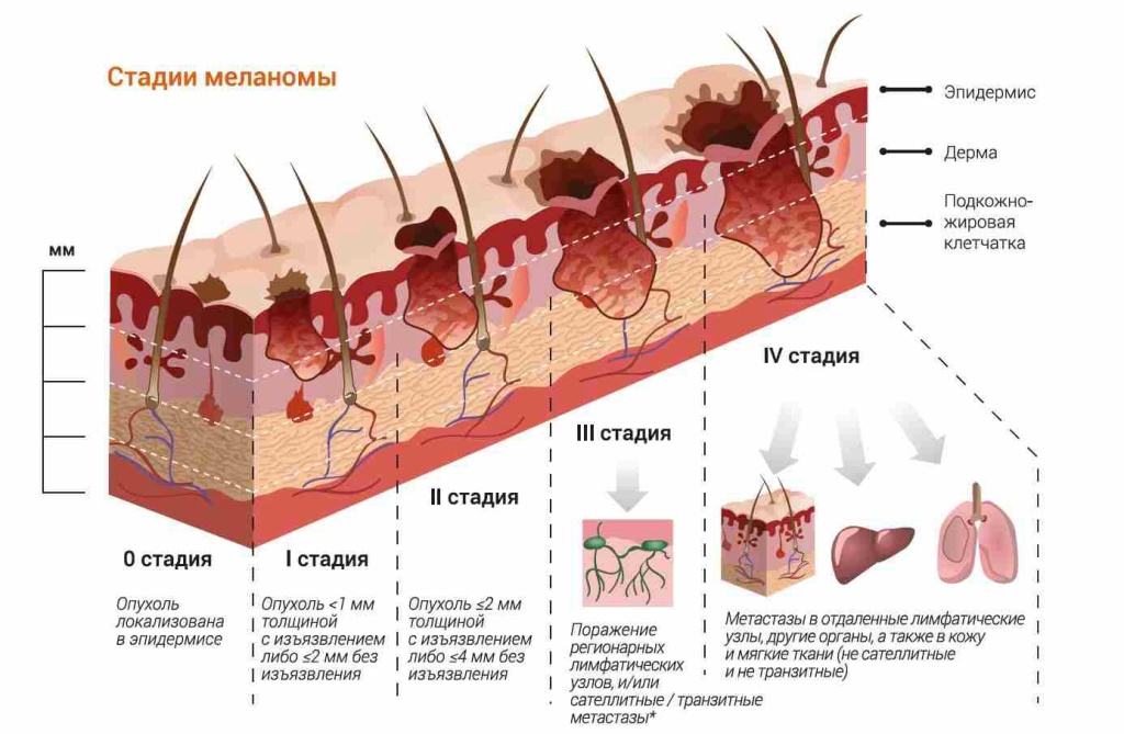 Меланома8 Меланома8