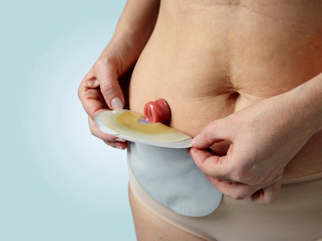 Колостома Колостома