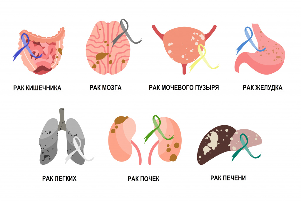 Карцинома12 Карцинома12