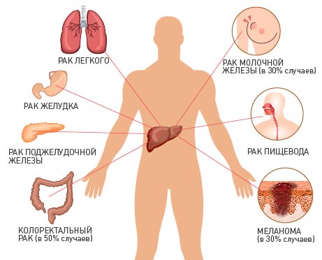 Метастазы2 Метастазы2